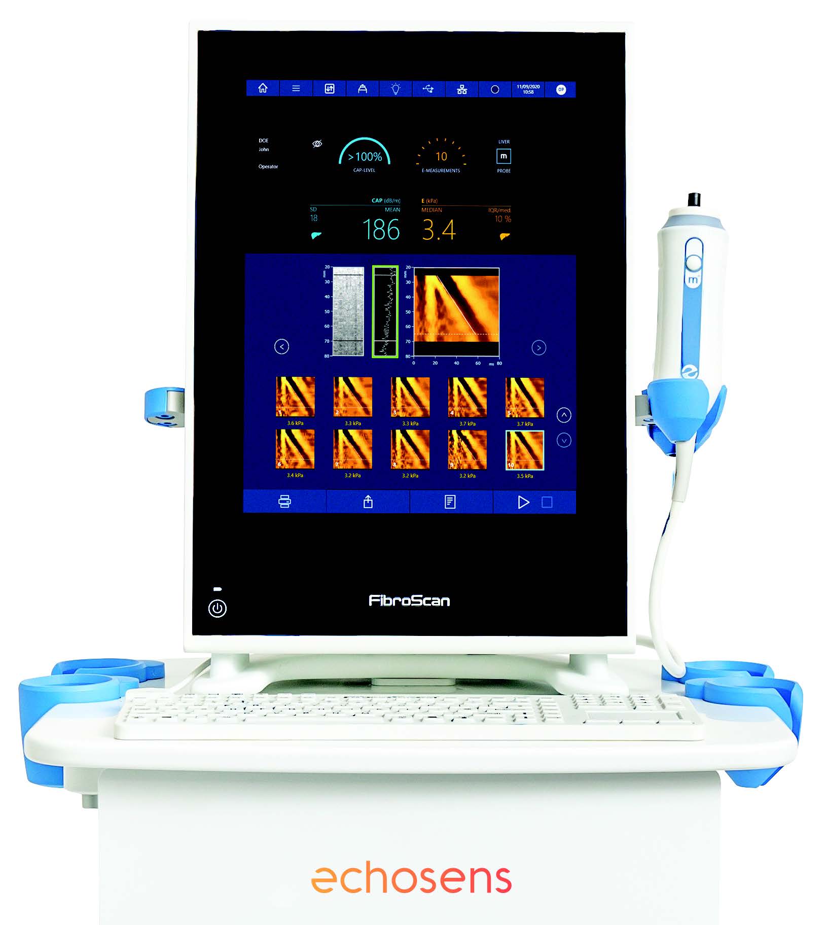 FibroScan